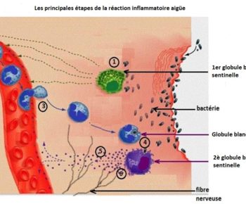 Contamination et infection : étapes de la réaction inflammatoire aigüe